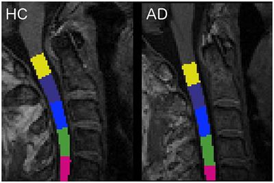 Unsuspected Involvement of Spinal Cord in Alzheimer Disease